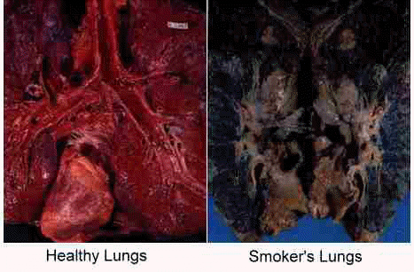 Lungs From Smoking
